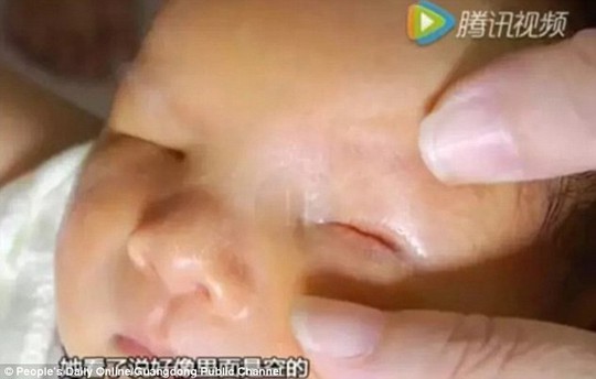 
Bé trai sinh ra với chứng bệnh không mắt hiếm gặp tại tỉnh Quảng Đông - Trung Quốc. Ảnh: Peoples Daily Online

