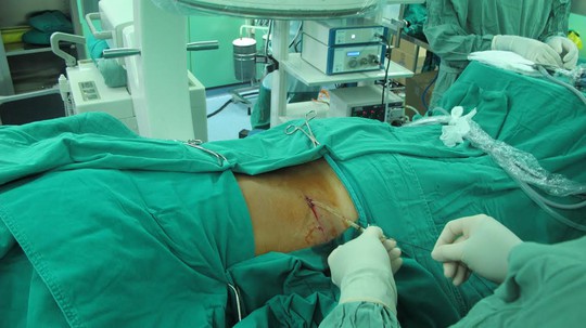 
Bệnh nhân được tán và lấy được 98% sỏi qua da.
