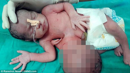 Bé gái Ấn Độ ra đời với một chiếc đầu thứ hai và một bàn tay thứ ba mọc ra từ bụng - ảnh DAILY MAIL
