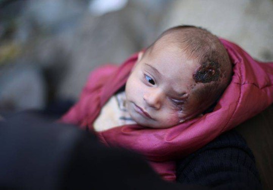 Syria: Xót thương bé 3 tháng tuổi chỉ còn một mắt - Ảnh 3.