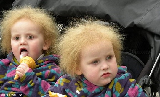 Hai cô bé song sinh bị hội chứng tóc xù - Ảnh 4.