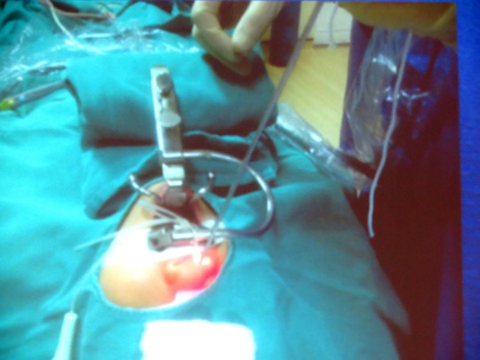 Một ca nạo V/A bằng dao plasma - ẢNH DO BỆNH VIỆN CUNG CẤP