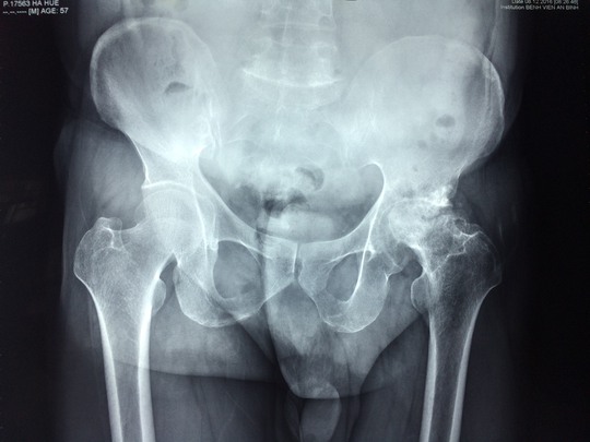 Khớp háng chân trái (bên phải phim X-quang) sau nhiều năm mắc bệnh đã bị hư hỏng, chân trái cũng bị ngắn đi do một phần xương tự tiêu và tạo nên tư thế xiêu vẹo khi bệnh nhân di chuyển