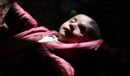 Syria: Xót thương bé 3 tháng tuổi chỉ còn một mắt - Ảnh 2.
