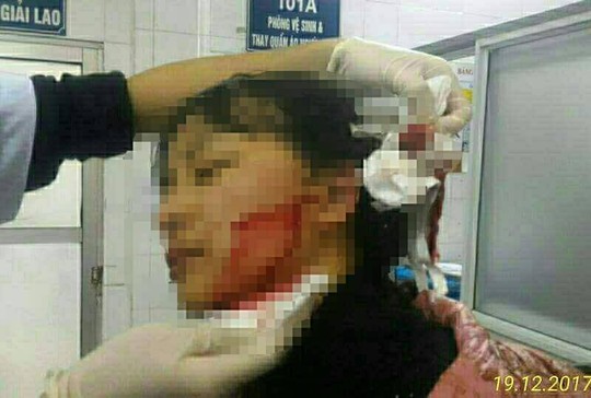 Nữ sinh 16 tuổi bị rạch mặt phải khâu gần 40 mũi - Ảnh 1.