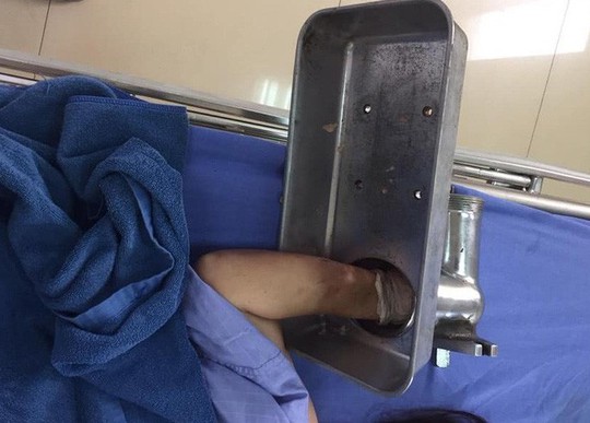 Máy xay thịt nuốt trọn bàn tay, nạn nhân vác máy đến cầu cứu bác sĩ - Ảnh 1. Máy xay thịt nuốt trọn bàn tay, nạn nhân vác máy đến cầu cứu bác sĩ - Ảnh 1.