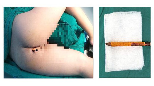 Ớn lạnh hình ảnh bé trai bị bị bút chì đâm thấu mông đến 8 cm - Ảnh 1. Ớn lạnh hình ảnh bé trai bị bị bút chì đâm thấu mông đến 8 cm - Ảnh 1.