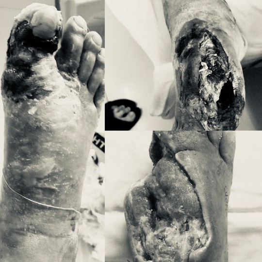 Bác sĩ rùng mình cứu bàn chân hoại tử do bệnh nhân tự chữa đái tháo đường - Ảnh 2.