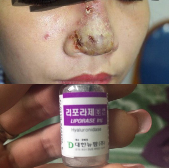 Cô gái 23 tuổi bị hoại tử mũi sau tiêm filler tại một spa - Ảnh 1. Cô gái 23 tuổi bị hoại tử mũi sau tiêm filler tại một spa
