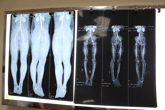 Nghĩ đau do đá banh, ai ngờ 4 năm tắc mạch - Ảnh 1.