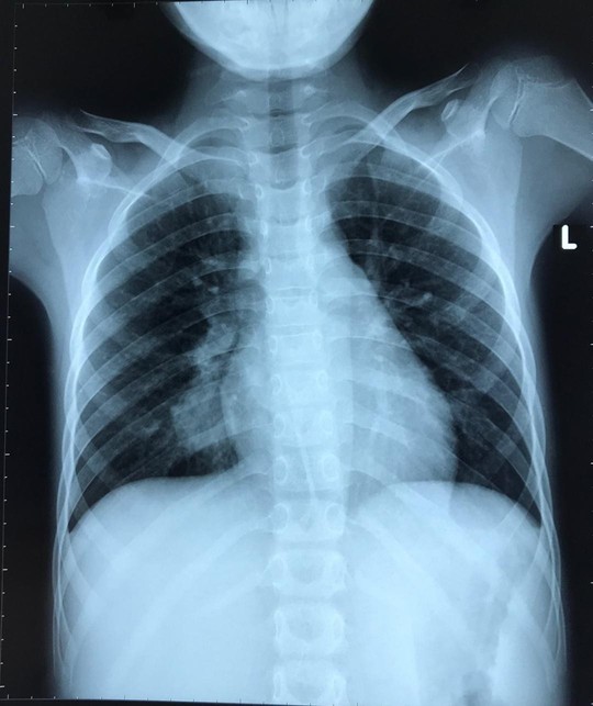 Qua 3 bệnh viện, ca bệnh phổi hiếm gặp được cứu - Ảnh 1.