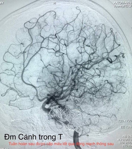 Lần đầu tiên can thiệp mạch máu não cho bệnh nhi đang tỉnh táo - Ảnh 1.