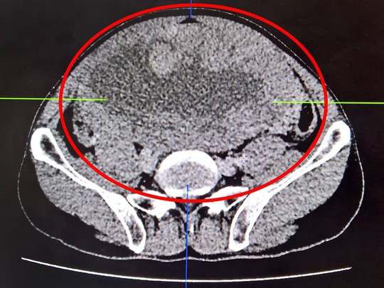 Ăn khó tiêu, vào viện phát hiện vòng hai u khủng - Ảnh 1.
