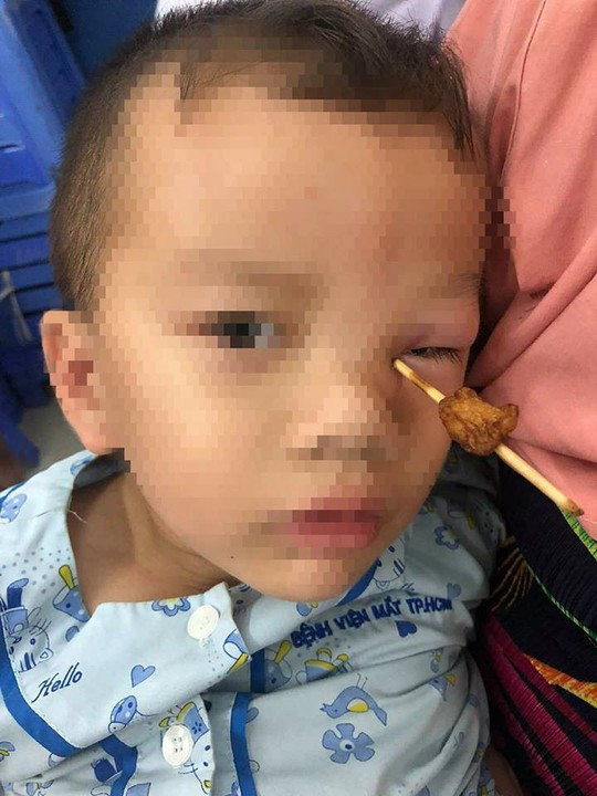 Đứt lệ quản do que tâm xuyên vào hốc mắt 3cm - Ảnh 1. Đứt lệ quản do que tâm xuyên vào hốc mắt 3cm - Ảnh 1.