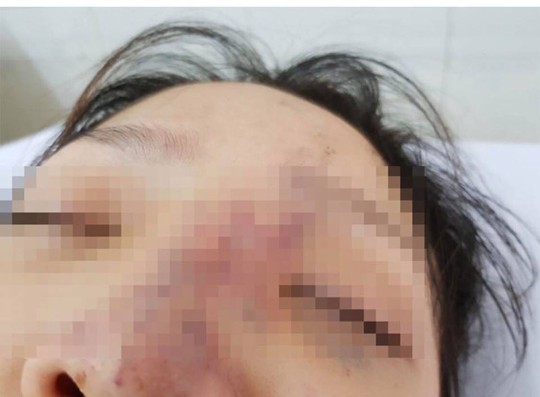 Một nữ sinh có nguy cơ mù mắt vì tiêm filler - Ảnh 1.