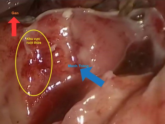 Ca vỡ ruột thừa hiếm gặp khiến bác sĩ đau đầu - Ảnh 1.