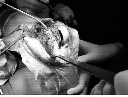 Ghép xương từ người hiến chết não cứu chân bệnh nhân bị u tế bào khổng lồ - Ảnh 3.