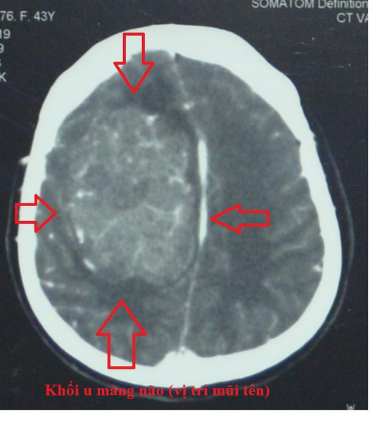 Sau giải thích của bác sĩ, bệnh nhân u não được cứu sống ngoạn mục - Ảnh 2.