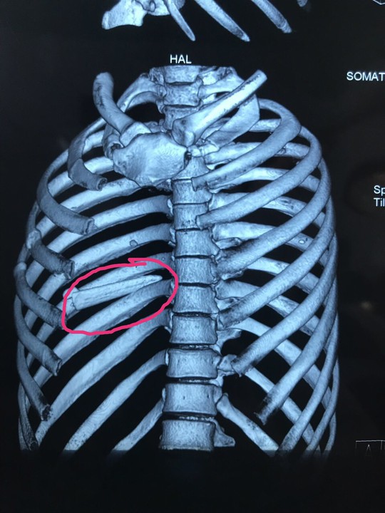 Cứu sống người bị mũi kiếm của cá kiếm đâm thấu phổi  - Ảnh 1.