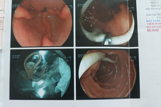 Tưởng đau dạ dày, hoá ra lươn chui vào ruột - Ảnh 2.