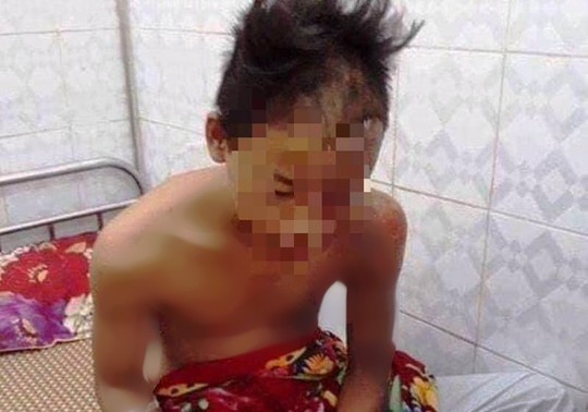 Nam sinh 15 tuổi may mắn thoát chết khi bị sét đánh cháy sém đầu - Ảnh 1.