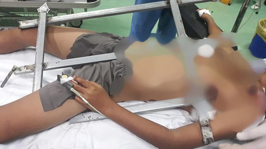 Rơi từ cây cao khi chơi trốn tìm, bé trai bị hàng rào sắt đâm xuyên ngực - Ảnh 1.