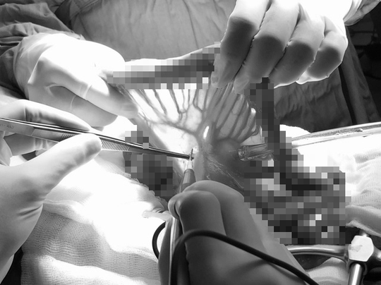 1 tháng nuốt vướng, ho đờm, người đàn ông phát hiện ung thư giai đoạn cuối - Ảnh 1.