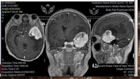 Bác sĩ giật mình với khối u não khổng lồ của một đồng nghiệp - Ảnh 1.