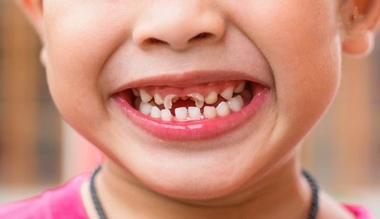 Răng sữa bị mủn vỡ đến sát lợi, có sao không? - Ảnh 1.