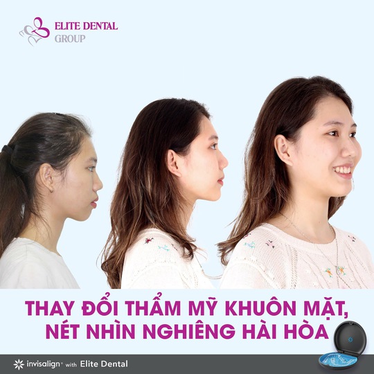 Chỉnh nha để cân đối tỉ lệ vàng mũi - môi - cằm - Ảnh 3.