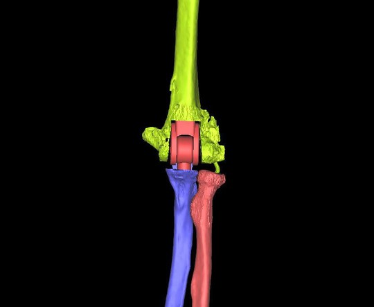 Sau 26 năm, cánh tay biến dạng lần đầu được hồi phục nhờ công nghệ 3D - Ảnh 2.