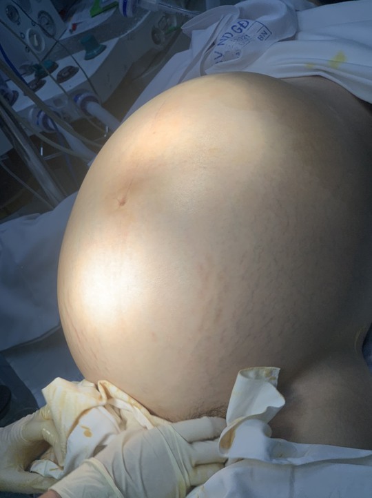 Nữ du học sinh 18 tuổi về nước để cắt bỏ khối u 22 kg ở bụng - Ảnh 1.