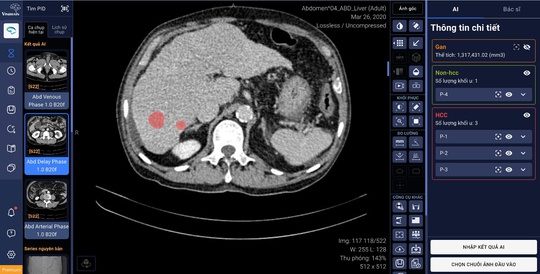 VinBrain cùng Bệnh viện ĐH Y dược TP HCM phát hiện và chẩn đoán ung thư gan bằng AI - Ảnh 1.