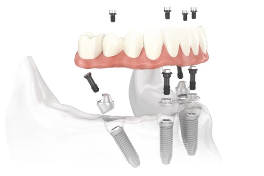 Trồng răng Implant phục hồi mất răng toàn hàm: tạm biệt hàm tháo lắp, sang trang cuộc đời - Ảnh 2.