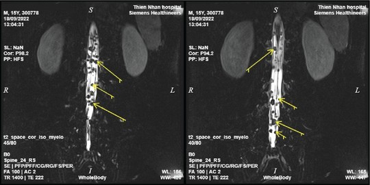Chụp MRI toàn thân, phát hiện kịp thời ung thư di căn - Ảnh 3.