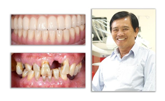 Giải pháp tối ưu trong điều trị mất răng toàn hàm từ nghiên cứu khoa học của Tiến sĩ Trần Hùng Lâm - Ảnh 1.