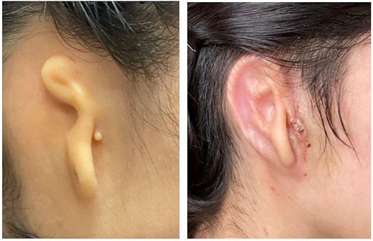 Lần đầu tiên trên thế giới: In 3D tai người, cấy ghép thành công cho cô gái - Ảnh 3.