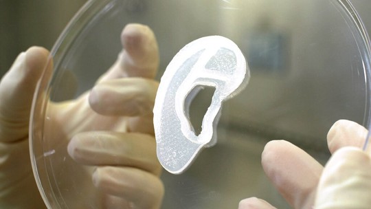 Lần đầu tiên trên thế giới: In 3D tai người, cấy ghép thành công cho cô gái - Ảnh 2.