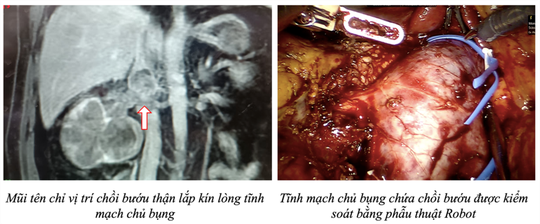 Robot cắt thận và lấy chồi bướu ca bệnh đầu tiên Việt Nam - Ảnh 1.