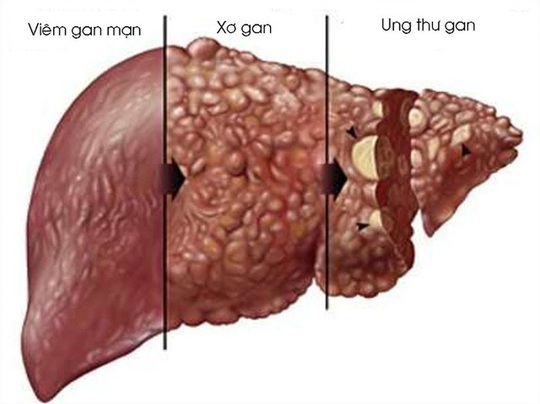 Bác sĩ đưa bí kíp bảo vệ lá gan ngày Tết - Ảnh 1.