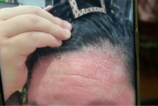 Tắm thuốc trị vảy nến, nữ bệnh nhân bội nhiễm toàn thân - Ảnh 1.