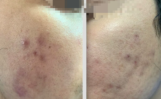 Tiêm chất làm đẹp da, nam thanh niên bị biến chứng vùng mặt - Ảnh 1.
