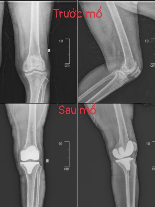 Người đàn ông hư toàn bộ hai khớp gối sau 15 năm chịu đau - Ảnh 1.