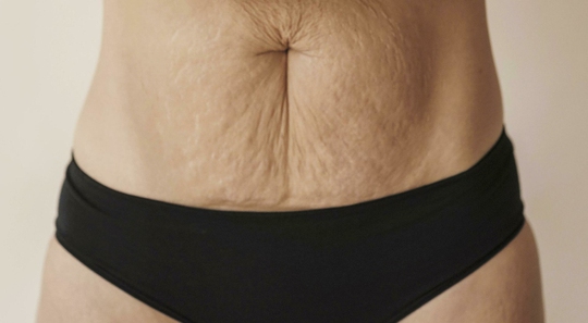 7 cách khắc phục da bụng chảy xệ sau giảm cân - Ảnh 1.