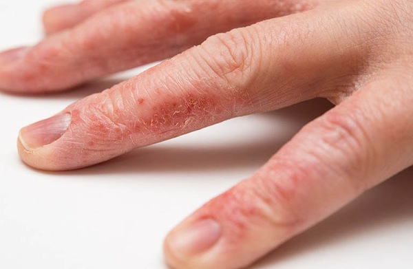 Bệnh chàm da chân có thể lan sang các vùng khác trên cơ thể không? 
