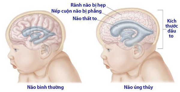 Có những biến chứng và tác động kéo dài nào do não úng thủy bẩm sinh gây ra?
