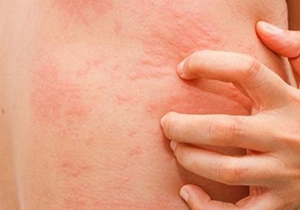 Những điều cần lưu ý khi bạn mắc bệnh ngoài da?
