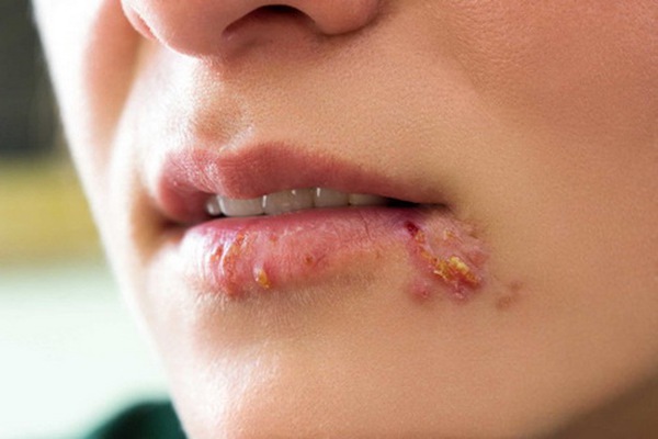 Virus herpes được truyền từ quan hệ bằng miệng có thể gây bệnh gì?
