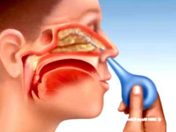 Cách rửa mũi để tránh rửa mũi bị đau tai ở người lớn hiệu quả