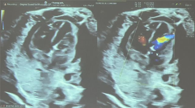 TP HCM: Thêm một thai nhi được "sửa chữa" tim- Ảnh 1.